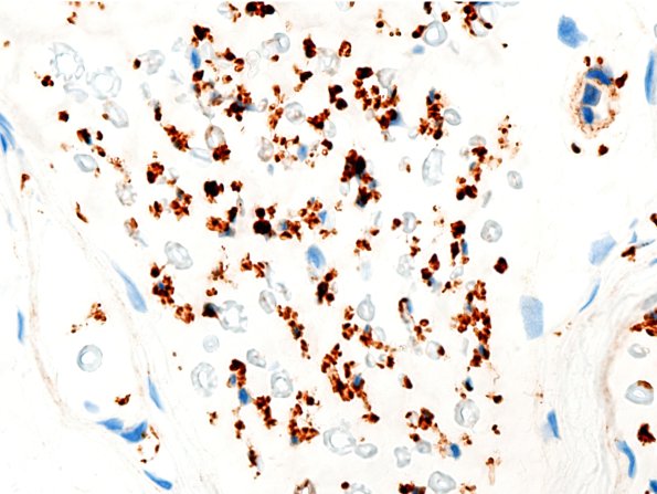 3A4 Nerve fibers (Case 3) CD56 IHC NCAM 100X 2