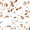 3A5 Nerve fibers (Case 3) CD56 IHC NCAM 100X 3