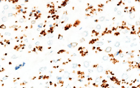 3A5 Nerve fibers (Case 3) CD56 IHC NCAM 100X 3