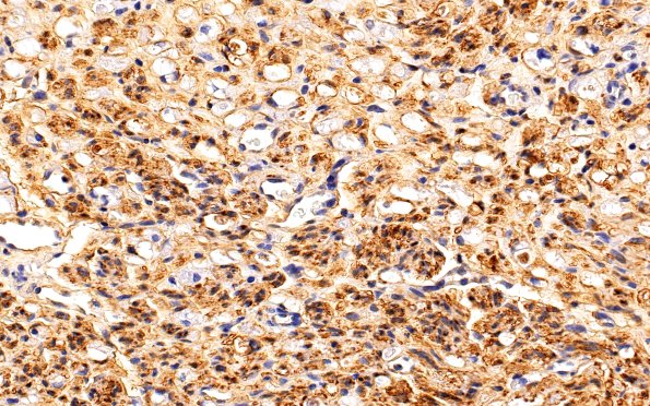 3B2 Nerve fibers (Case 3) S100 40X