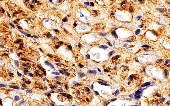 3B3 Nerve fibers (Case 3) S100 100X 1