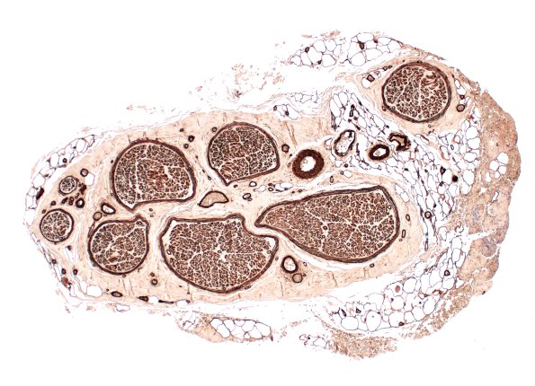 4A1 Nerve fibers (Case 4) Coll IV 4X