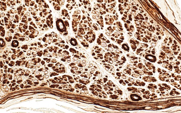 4A2 Nerve fibers (Case 5) Coll IV 40X 2