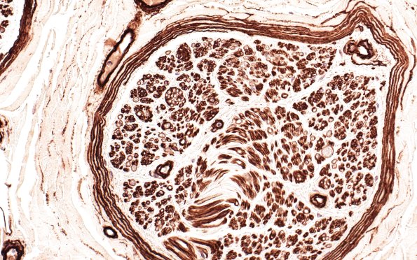 5A Nerve fibers (Case 4) Coll IV 40X