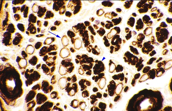 6A Normal Sural Nerve Coll IV 1 copy