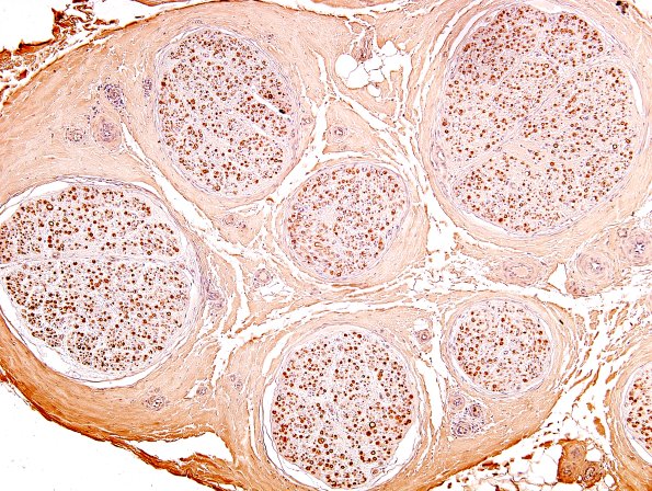 7A1 Nerve, normal Myelin Basic Protein (ts) 3