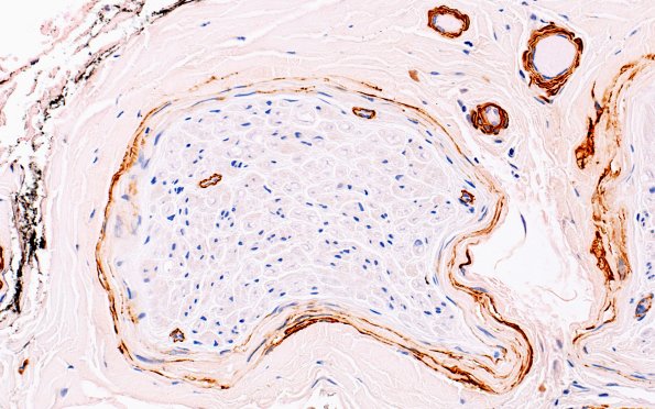 8A2 Nerve fibers (Case 7) SMA