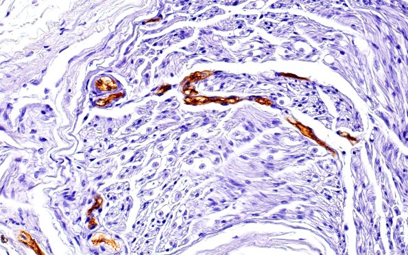 9A2 Ulex (Case 8) 40X 1