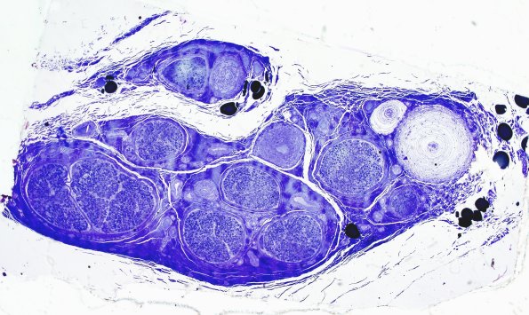 10A1 Normal sural nerve (Case 10) Pacinian corpuscle Plastic 3