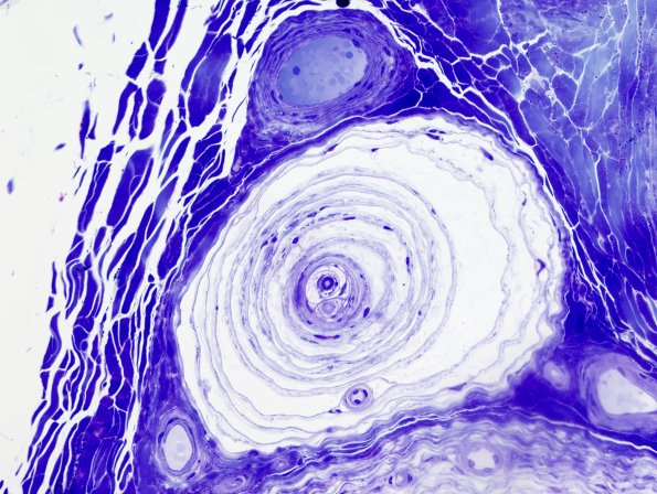 10A3 Normal sural nerve (Case 10) Pacinian corpuscle Plastic 1