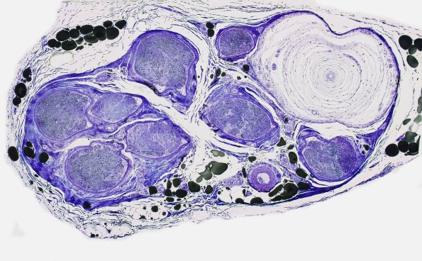 11A Normal Nerve (Case 11) Pacinian corpuscle plastic 1