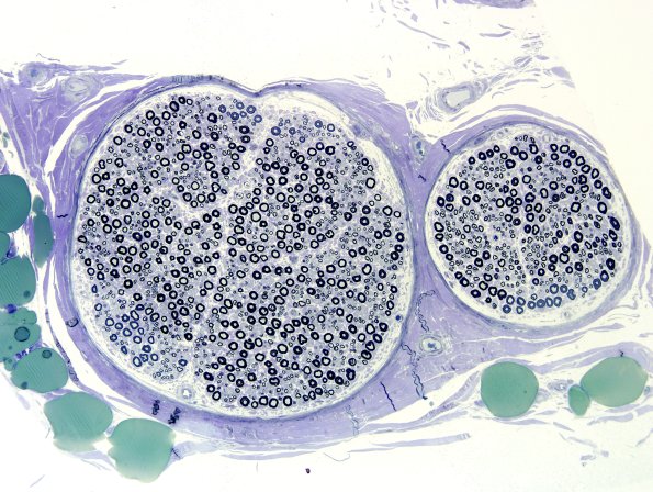 12A1 Normal Nerve (Case 12) Plastic 5