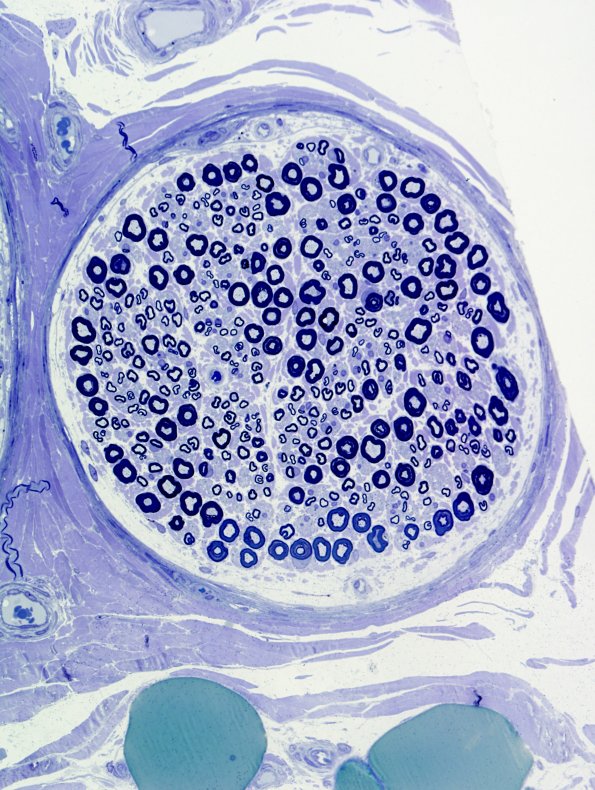 12A2 Normal Nerve (Case 12) Plastic 6