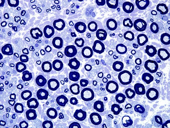 12A4 Normal Nerve (Case 12) Plastic 8