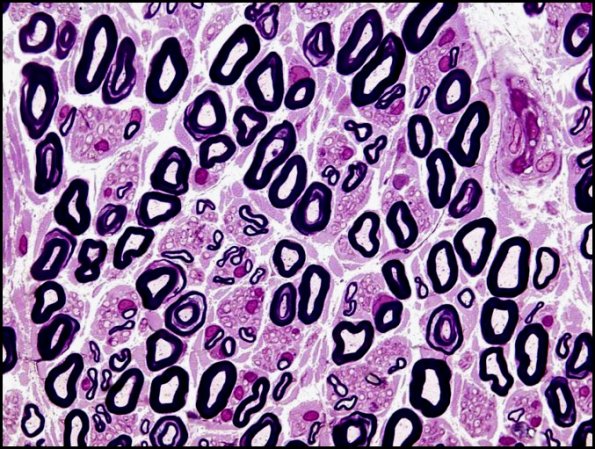 13A Higher mag normal Plastic (Case 13).