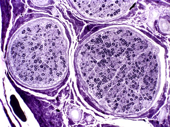 14A2 Normal sural nerve (Case 14) best