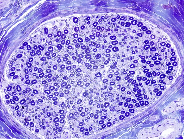 15A2 Normal sural nerve (Case 15) Plastic 5