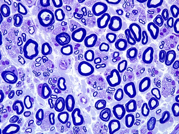 16A1 Normal Nerve (Case 16) Plastic 3.jpg