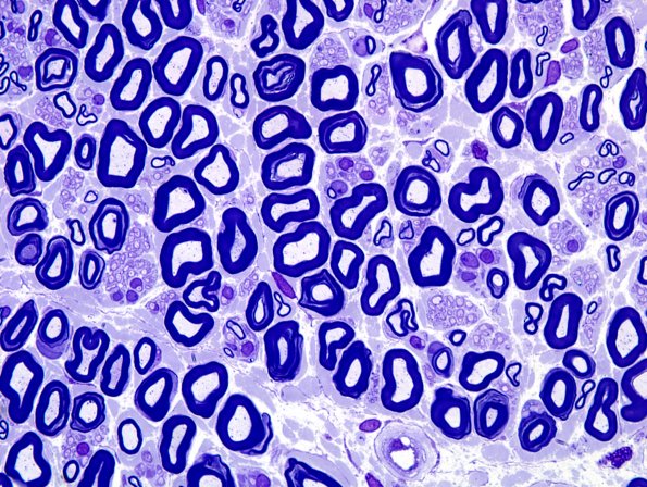 16A2 Normal Nerve (Case 16) Plastic 5.jpg