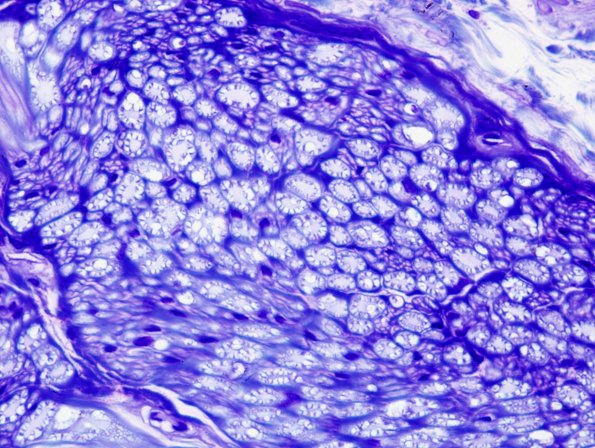 17A Normal Nerve (Case 17) artifact
