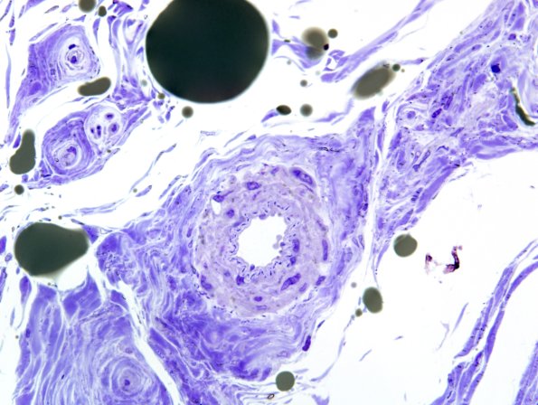 18A Normal nerve, epineurial arterioles (Case 18) Plastic 1