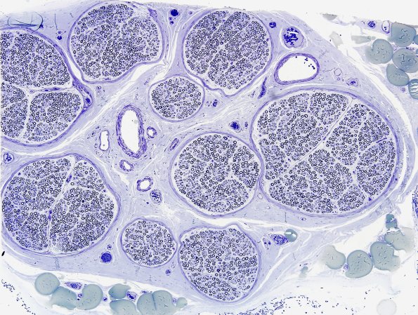 1A1 Normal (near normal) Nerve (Case 1) 100X Plastic 2A