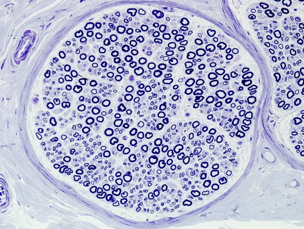 1A3 Normal (near normal) Nerve (Case 1) 100X Plastic 1A