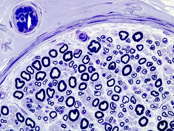 1A4 Normal (near normal) Nerve (Case 1) 100X Plastic 11