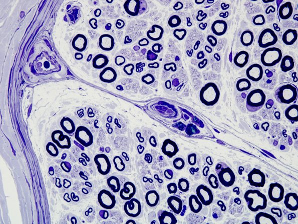 1A7 Normal (near normal) Nerve (Case 1) 100X Plastic  7