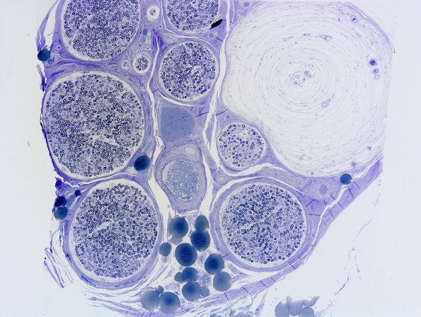 21A1 Pacinian Corpuscle (Case 21) Plastic 2