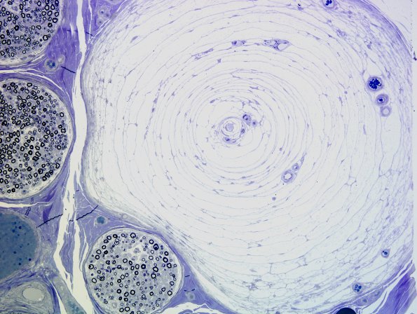 21A2 Pacinian Corpuscle (Case 21) Plastic 1