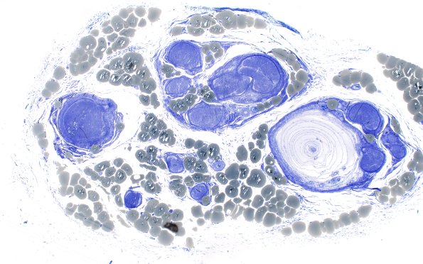 22A1 Pacinian corpuscle (Case 22) Plastic 4X