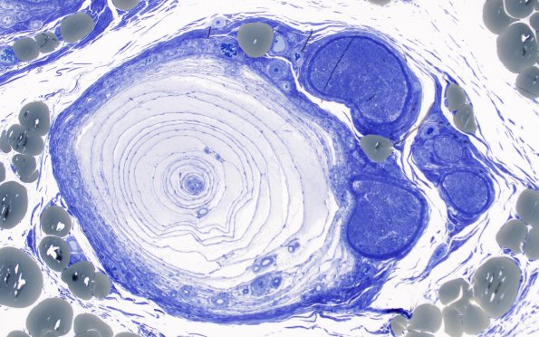 22A2 Pacinian corpuscle (Case 22) Plastic 10X