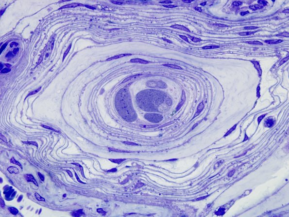 23A2 Pacinian corpuscle, intrafascicular (Case 23) Plastic 100X