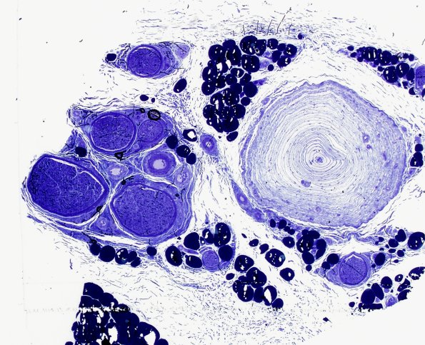 24A Pacinian Corpuscle (Case 24) Plastic 4x a.jpg