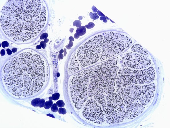 2A1 Normal Nerve (Case 2) Plastic 3