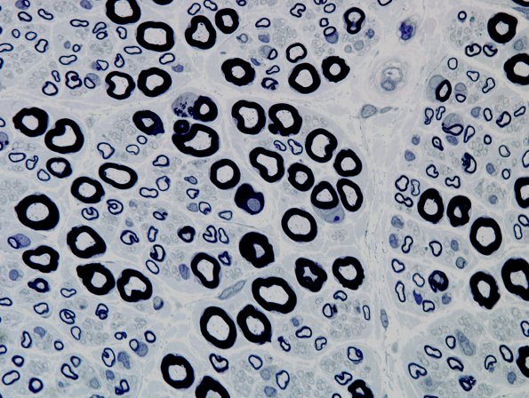 2A2 Normal Nerve (Case 2) 3.jpg