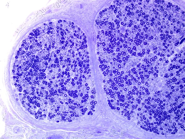 3A2 Nearly Normal Nerve, pi granules (Case 3) Plastic 19.jpg
