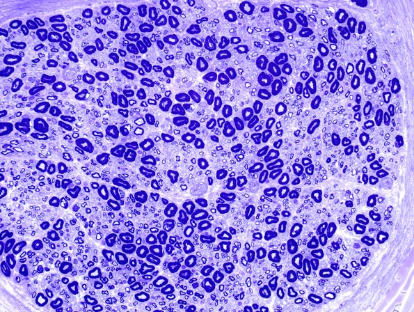 3A3 Nearly Normal Nerve, pi granules (Case 3) Plastic 12.jpg