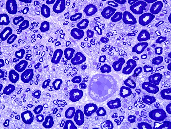3A4 Nearly Normal Nerve, pi granules (Case 3) Plastic 14.jpg