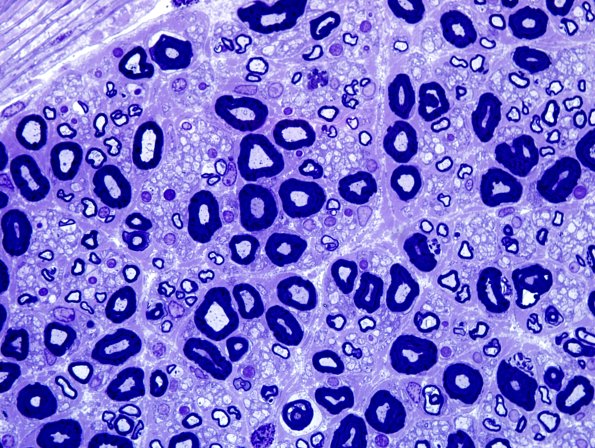 3A5 Nearly Normal Nerve, pi granules (Case 3) Plastic 3.jpg