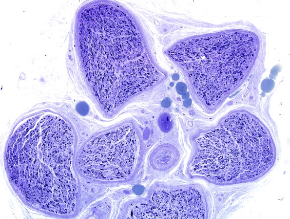 4A1,2 1C15 Nerve, near normal (Case 4) Plastic 4.jpg