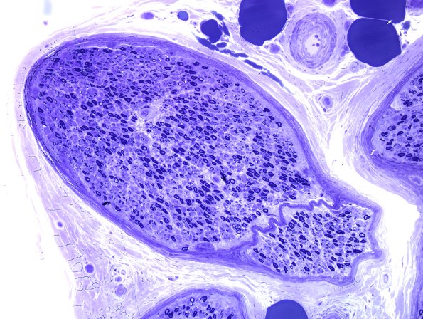 4A2 Nerve, near normal (Case 4) Plastic 7.jpg