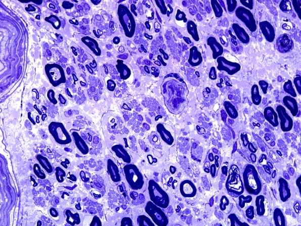 4A4 Nerve, near normal (Case 4) Plastic 1.jpg