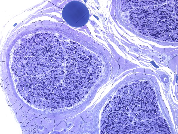 5A2 Nerve, near normal (Case 5) Plastic 2.jpg