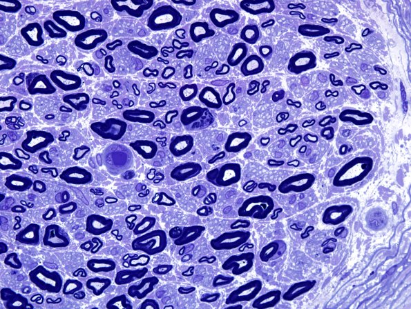 5A3 Nerve, near normal (Case 5) Plastic 5.jpg