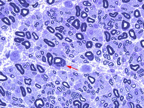 6A1 Nerve, near normal (Case 6) Plastic 6 copy.jpg