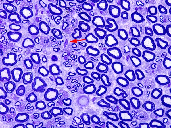 6A2 Nerve, normal (Case 6) Plastic 100X 1 copy.jpg