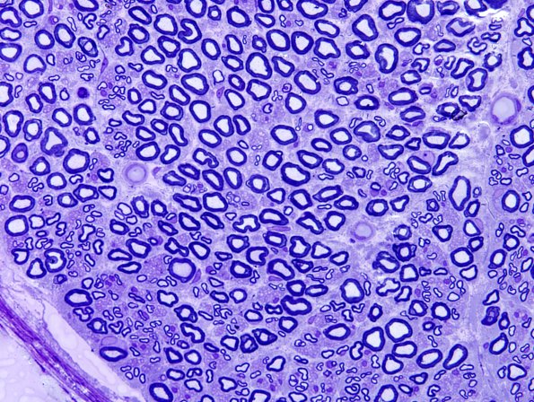 6A3 Nerve, normal (Case 6) Plastic 60X 1.jpg