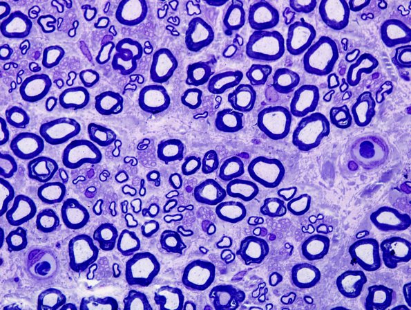 6A4 Nerve, normal (Case 6) Plastic 100X 4.jpg